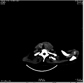甲状腺结节性病变CT诊断及鉴别诊断