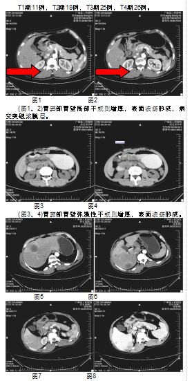 多层螺旋ct对胃癌的诊断价值评价