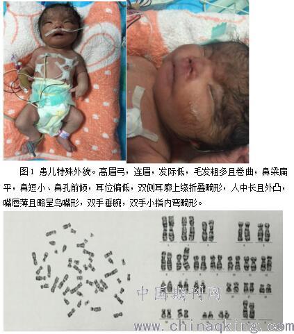 新生儿德朗综合征1例