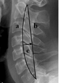 强直性脊柱炎胸腰椎后凸畸形患者颈椎活动受限