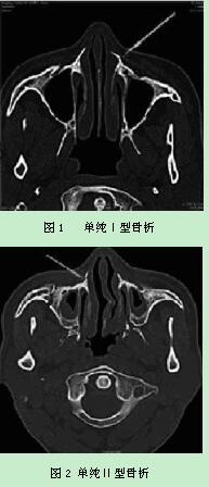 鼻骨骨折的ct诊断价值及其对法医鉴定的意义