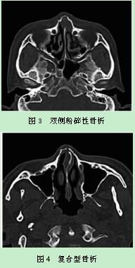 鼻骨骨折的ct诊断价值及其对法医鉴定的意义