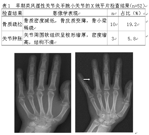 早期类风湿性关节炎手腕小关节核磁共振的临床分析