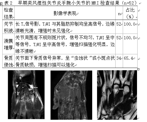 早期类风湿性关节炎手腕小关节核磁共振的临床