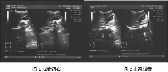 典型胆囊结石超声图像特点:(1)胆囊形态清晰