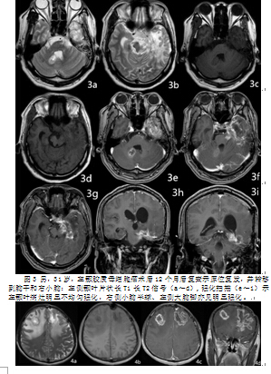 幕上恶性胶质瘤术后异位复发的多因素临床分析