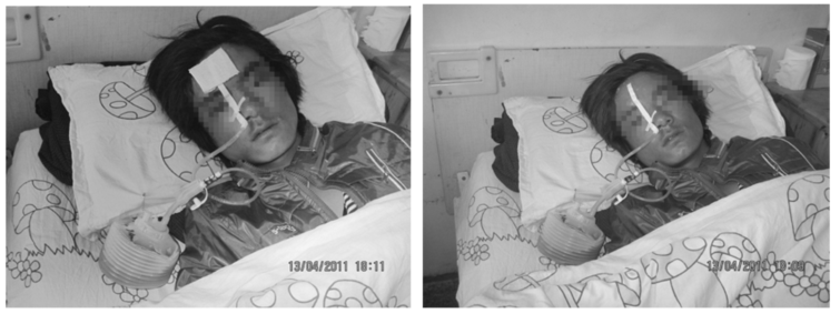 胃管固定新方法