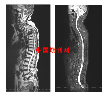 1.5t umr全景矩阵成像技术在全脊柱检查中的临床应用