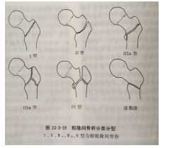 股骨髁上骨牵引治疗老年人股骨粗隆间骨折