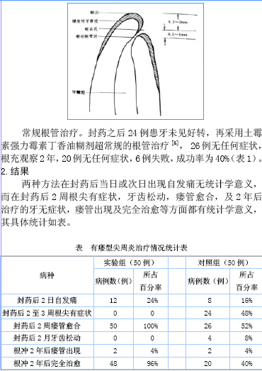 超常规根管预备治疗有瘘型根尖炎的临床研究-中国期刊网