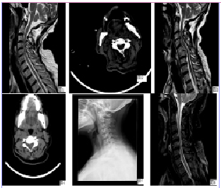 颈椎病dr/ct/mri影像学比较诊断价值的分析