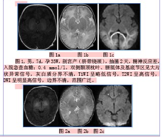 MRI及DWI在新生儿低血糖脑损伤中的应用