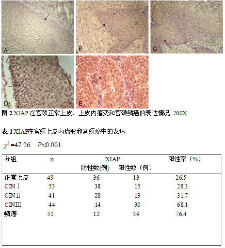 宫颈上皮内瘤变及鳞癌组织中表达的临床病理学