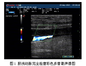 彩色多普勒超声在急性下肢动脉栓塞中的应用价