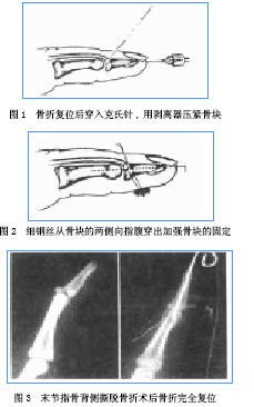 采用切开复位治疗,末节指骨过伸位,顺时针或者逆时针穿入克氏针,在用