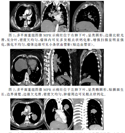 肺硬化性血管瘤的MSCT诊断分析