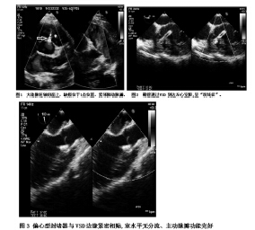 经食管超声心动图在小儿干下型室间隔缺损微创镶嵌手术中的应用