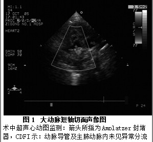 超声心动图在amplatzer封堵器介入治疗先心病中的应用价值