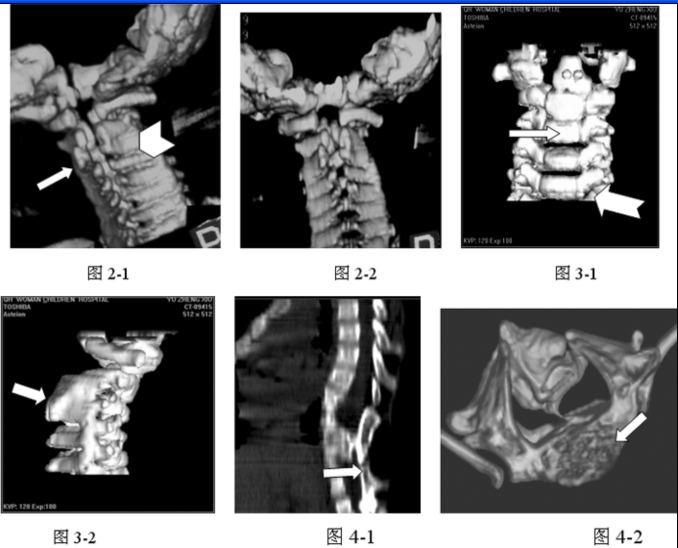 2例隐性脊柱裂:x线平片确诊1例,疑诊1例,ct确诊2例,表现为