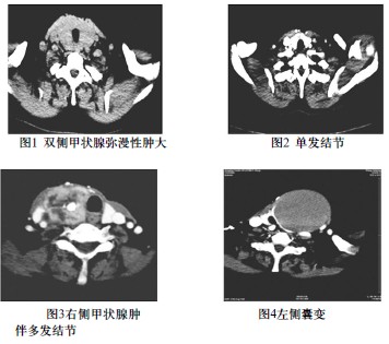 结节性甲状腺肿的ct诊断